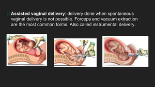 Assisted vaginal delivery: delivery done when spontaneous
vaginal delivery is not possible. Forceps and vacuum extraction
are the most common forms. Also called instrumental delivery.
 