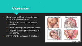 Caesarian
Baby removed from uterus through
incision in abdomen when
Baby is in breech or crosswise
position
Head too large for mother’s pelvis
Vaginal bleeding has occurred in
pregnancy
29.1% of U.S. births are C-sections
 