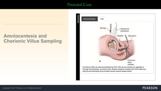 Copyright © 2017 Pearson, Inc. All Rights Reserved
Prenatal Care
Amniocentesis and
Chorionic Villus Sampling
 