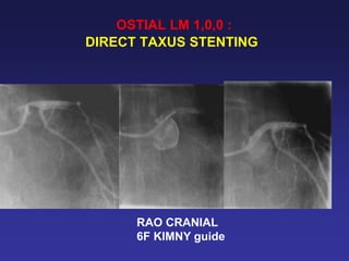 OSTIAL LM 1,0,0 :
DIRECT TAXUS STENTING




      RAO CRANIAL
      6F KIMNY guide
 