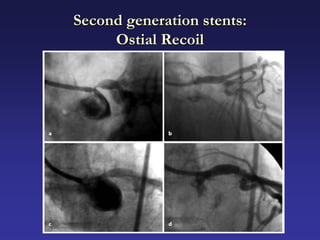 Second generation stents:
     Ostial Recoil
 