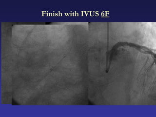 Finish with IVUS 6F
 
