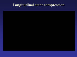Longitudinal stent compression
 