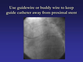 Use guidewire or buddy wire to keep
guide catheter away from proximal stent
 