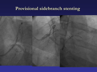 Provisional sidebranch stenting
 