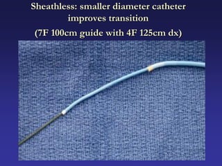 Sheathless: smaller diameter catheter
         improves transition
 (7F 100cm guide with 4F 125cm dx)
 