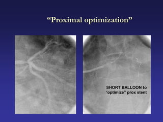 “Proximal optimization”




               SHORT BALLOON to
               „optimize” prox stent
 