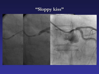 “Sloppy kiss”
 