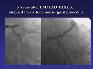 5 Years after LM/LAD TAXUS…
stopped Plavix for a nonsurgical procedure
 