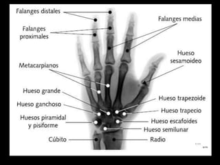 • Si se produjo una amputación transversal, nítida, distal al
tercio proximal de la matriz ungueal‚ con exposición ósea,
l...