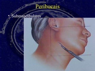 Peribucais
• Submandibulares
 