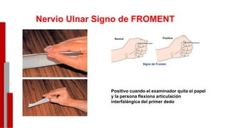 Nervio Ulnar Signo de FROMENT
Positivo cuando el examinador quita el papel
y la persona flexiona articulación
interfalángica del primer dedo
-
 