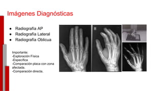 Imágenes Diagnósticas
● Radiografía AP
● Radiografía Lateral
● Radiografía Oblicua
-
Importante:
-Exploración Física
-Específica
-Comparación placa con zona
afectada.
-Comparación directa.
 