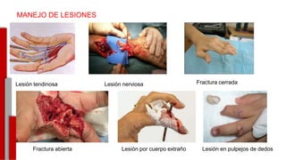 -
MANEJO DE LESIONES
Lesión tendinosa Lesión nerviosa Fractura cerrada
Lesión por cuerpo extrañoFractura abierta Lesión en pulpejos de dedos
 