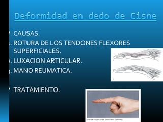  CAUSAS.
1. ROTURA DE LOS TENDONES FLEXORES
SUPERFICIALES.
2. LUXACION ARTICULAR.
3. MANO REUMATICA.
 TRATAMIENTO.
 