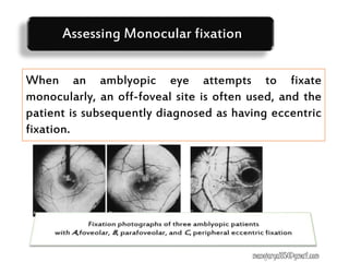 When an amblyopic eye attempts to fixate
monocularly, an off-foveal site is often used, and the
patient is subsequently diagnosed as having eccentric
fixation.
Assessing Monocular fixation
manojaryal85@gmail.com
 
