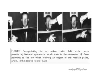 FIGURE Past-pointing in a patient with left sixth nerve
paresis. A, Normal egocentric localization in dextroversion. B, Past-
pointing to the left when viewing an object in the median plane,
and C, in the paretic field of gaze
manojaryal85@gmail.com
 
