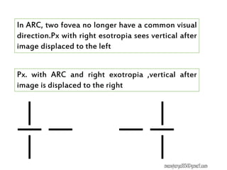 Px. with ARC and right exotropia ,vertical after
image is displaced to the right
manojaryal85@gmail.com
In ARC, two fovea no longer have a common visual
direction.Px with right esotropia sees vertical after
image displaced to the left
 