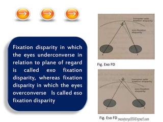 Fixation disparity in which
the eyes underconverse in
relation to plane of regard
is called exo fixation
disparity, whereas fixation
disparity in which the eyes
overconverse Is called eso
fixation disparity
Fig. Exo FD
Fig. Eso FD manojaryal85@gmail.com
 