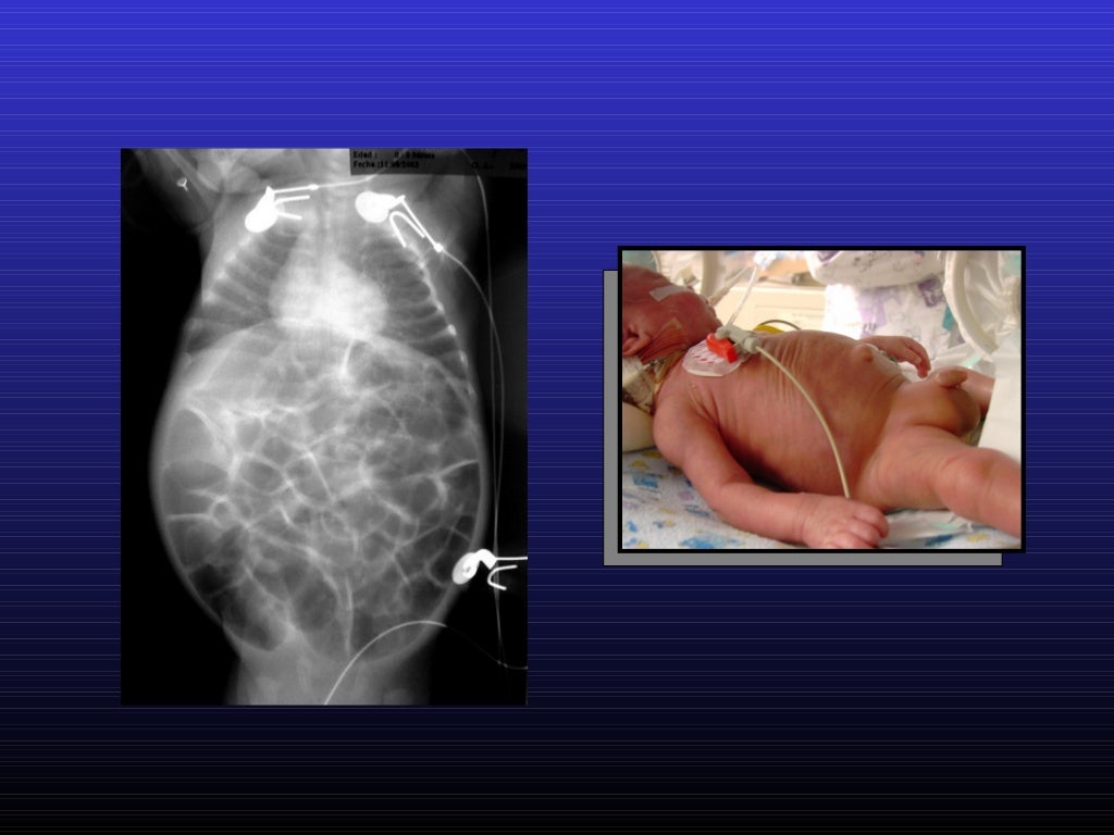 Manometria Anorretal Onde Fazer Sp Manometria Anorectal Quito