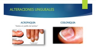 ALTERACIONES UNGUEALES
ACROPAQUIA
“Dedos en palillo de tambor”
COILONIQUIA
 