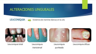 LEUCONIQUIA Existencia de manchas blancas en la uña
Leuconiquia total Leuconiquia
transversal
Leuconiquia
punteada
Leuconiquia difusa
ALTERACIONES UNGUEALES
 