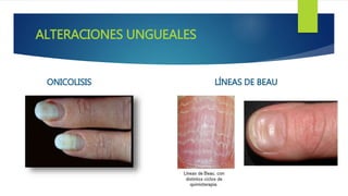 ALTERACIONES UNGUEALES
ONICOLISIS LÍNEAS DE BEAU
 