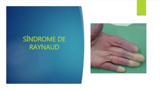 SÍNDROME DE
RAYNAUD
 