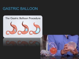 GASTRIC BALLOON
 