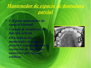 Mantenedor de espacio de dentadura parcial Útil para mantenedor de espacio bilateral. Ventaja de restablecer la función oclusal. Otra indicación es mantenedor de espacio posterior combinado con la reposición de los dientes anteriores por razones estéticas. 