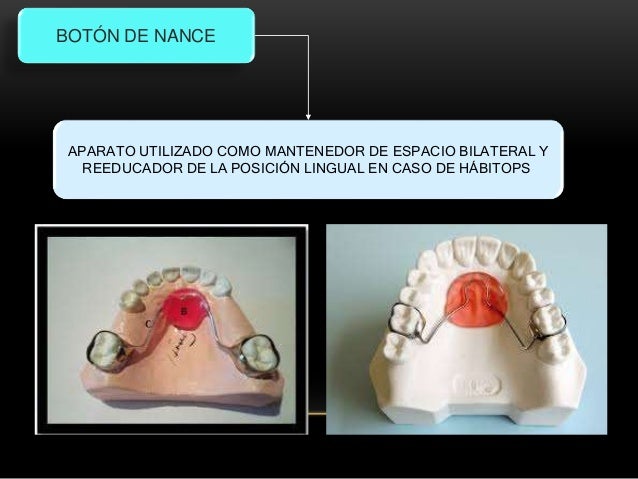 Mantenedores de espacio fijos