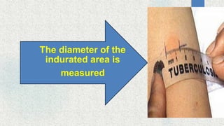 The diameter of the
indurated area is
measured
 