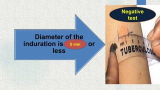 Diameter of the
induration is 10 mm or
less
Negative
test
5 mm
 