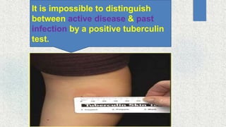 It is impossible to distinguish
between active disease & past
infection by a positive tuberculin
test.
 