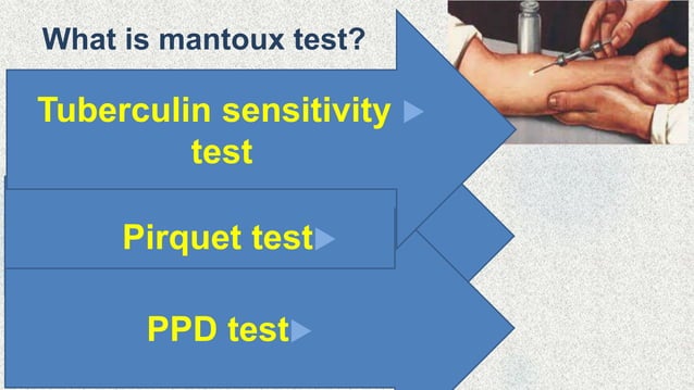 Mantoux Test Mantoux Test