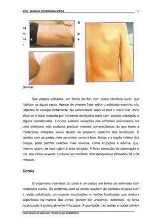 MGV - MANUAL DO GUARDA-VIDAS
A
nê
m o
na s
-
do-mar
São pólipos solitários, em forma de flor, com corpo cilíndrico curto, que
habitam as águas rasas. Apesar de viverem fixas sobre o substrato marinho, são
capazes de rastejar lentamente. Na extremidade superior está o disco oral, onde
situa-se a boca rodeada por inúmeros tentáculos orais com variada coloração e
alguns nematocistos. Embora existam variações nos sintomas provocados por
uma anêmona, não costuma produzir maiores conseqüências do que leves a
moderadas irritações locais devido ao pequeno tamanho dos tentáculos. O
contato com as partes mais sensíveis, como a face, lábios e a região inferior dos
braços, pode permitir reações mais severas, como erupções e edema, que,
mesmo assim, se restringem à área atingida. A forte sensação de queimação e
dor, nos casos severos, costuma ser imediata, mas desaparece passados 30 a 60
minutos.
Corais
O organismo individual do coral é um pólipo em forma de anêmona com
tentáculos curtos. Os acidentes com os corais resultam de contatos bruscos com
a região calcificada, provocando escoriações ou lesões localizadas que, embora
superficiais na maioria das vezes, podem ser urticantes, dolorosas, de lenta
cicatrização e potencialmente infectadas. A gravidade das lesões e cortes advém
COLETÂNEA DE MANUAIS TÉCNICOS DE BOMBEIROS
170
 