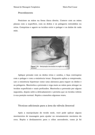 Manual de Massagem Terapêutica Mario-Paul Cassar 
Procedimento 
Posicione as mãos na fossa ilíaca direita. Comece com as mãos 
planas com a superfície, com os dedos e os polegares estendidos ou 
retos. Comprima e agarre os tecidos entre o polegar e os dedos de cada 
mão. 
Aplique pressão com os dedos retos e unidos, e faça contrapeso 
com o polegar e com a eminência tenar. Enquanto aplica a compressão, 
use a eminência hipotenar como uma alavanca para erguer os dedos e 
os polegares. Mantenha a preensão e erga mais as mãos para alongar os 
tecidos superficiais e mais profundos. Mantenha a preensão por alguns 
segundos, depois solte-a delicadamente e permita que os tecidos voltem 
à sua posição normal. Repita a manobra algumas vezes. 
Técnicas adicionais para a área da válvula ileocecal 
Após a manipulação do tecido mole, você pode aplicar alguns 
movimentos de massagem para ajudar no esvaziamento mecânico do 
ceco. Repita o deslizamento para o cólon ascendente, como já foi 
 