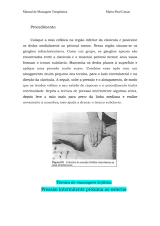 Manual de Massagem Terapêutica Mario-Paul Cassar 
Procedimento 
Coloque a mão cefálica na região inferior da clavícula e posicione 
os dedos medialmente ao peitoral menor. Nessa região situam-se os 
gânglios infraclaviculares. Como um grupo, os gânglios apicais são 
encontrados entre a clavícula e o músculo peitoral menor; seus vasos 
formam o tronco subclavio. Mantenha os dedos planos à superfície e 
aplique uma pressão muito suave. Combine essa ação com um 
alongamento muito pequeno dos tecidos, para o lado contralateral e na 
direção da clavícula. A seguir, solte a pressão e o alongamento, de modo 
que os tecidos voltem a seu estado de repouso e o procedimento tenha 
continuidade. Repita a técnica de pressão intermitente algumas vezes, 
depois leve a mão mais para perto da linha mediana e realize 
novamente a manobra; isso ajuda a drenar o tronco subclavio. 
Técnica de massagem linfática 
Pressão intermitente próxima ao esterno 
 