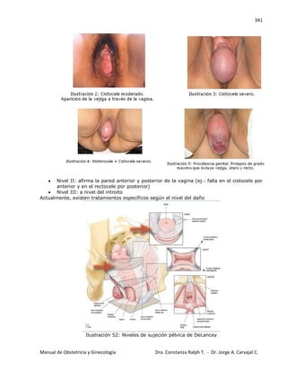 341
Manual de Obstetricia y Ginecología Dra. Constanza Ralph T. - Dr. Jorge A. Carvajal C.
Nivel II: afirma la pared anterior y posterior de la vagina (ej.: falla en el cistocele por
anterior y en el rectocele por posterior)
Nivel III: a nivel del introito
Actualmente, existen tratamientos específicos según el nivel del daño
Ilustración 52: Niveles de sujeción pélvica de DeLancey
 