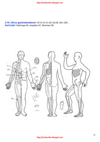 12
3.10. Ulcus gastroduodenal: VC13-12-10, E21-25,36, IG4, CS6 . .
Auricular: Estómago 95, simpático 57, Shenmen 58.
http://bookmedico.blogspot.com
http://bookmedico.blogspot.com
 