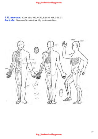 17
3.15. Neurosis: VG20, VB5, V10, VC12, E21-36, IG4, CS6, C7.
Auricular: Shenmen 58, subcórtex 18 y punto ansiolítico.
http://bookmedico.blogspot.com
http://bookmedico.blogspot.com
 