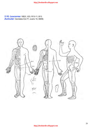 20
3.18. Leucorrea: VB23, V23, R13-11, B13.
Auricular: Genitales Ext.77, ovario 19, SM58.
http://bookmedico.blogspot.com
http://bookmedico.blogspot.com
 