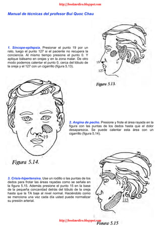 12
Manual de técnicas del profesor Bui Quoc Chau
1. Síncope-epilepsia. Presionar el punto 19 por un
rato, luego el punto 127 si el paciente no recupera la
conciencia. Al mismo tiempo presione el punto 0. Y
aplique bálsamo en orejas y en la zona malar. De otro
modo podemos calentar el punto 0, cerca del lóbulo de
la oreja y el 127 con un cigarrillo (figura 5.13).
2. Angina de pecho. Presione y frote el área rayada en la
figura con las puntas de los dedos hasta que el dolor
desaparezca. Se puede calentar esta área con un
cigarrillo (figura 5.14).
3. Crisis-hipertensiva. Use un rodillo o las puntas de los
dedos para frotar las áreas rayadas como se señala en
la figura 5.15. Además presione el punto 15 en la base
de la pequeña concavidad detrás del lóbulo de la oreja
hasta que la TA baje al nivel normal. Haciéndolo como
se menciona una vez cada día usted puede normalizar
su presión arterial.
http://bookmedico.blogspot.com
http://bookmedico.blogspot.com
 