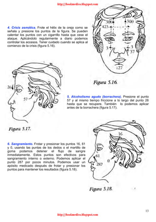 13
4. Crisis asmática. Frote el hélix de la oreja como se
señala y presione los puntos de la figura. Se pueden
calentar los puntos con un cigarrillo hasta que cese el
ataque. Aplicándolo regularmente a diario podemos
controlar los accesos. Tener cuidado cuando se aplica al
comienzo de la crisis (figura 5.16).
5. Alcoholismo agudo (borrachera). Presione el punto
57 y al mismo tiempo friccione a lo largo del punto 26
hasta que se recupere. También lo podemos aplicar
antes de la borrachera (figura 5.17).
6. Sangramiento. Frotar y presionar los puntos 16, 61
y 0, usando las puntas de los dedos o el martillo de
goma podemos detener el flujo de sangre
inmediatamente. Estos puntos son efectivos para
sangramiento interno o externo. Podemos aplicar el
punto 287 por pocos minutos. Podemos usar un
apósito medicado después de frotar y presionar los
puntos para mantener los resultados (figura 5.18).
http://bookmedico.blogspot.com
http://bookmedico.blogspot.com
 