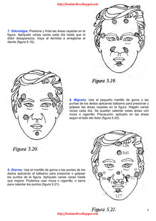 14
7. Odontalgia. Presione y frote las áreas rayadas en la
figura. Aplíquelo varias veces cada día hasta que el
dolor desaparezca. Vaya al dentista a arreglarse el
diente (figura 5.19).
8. Migraña. Use el pequeño martillo de goma o las
puntas de los dedos aplicando bálsamo para presionar y
golpear las áreas rayadas en la figura. Hágalo varias
veces cada día. Se pueden calentar estas áreas con
moxa o cigarrillo. Precaución: aplicarlo en las áreas
según el lado del dolor (figura 5.20).
9. Diarrea. Use el martillo de goma o las puntas de los
dedos aplicando el bálsamo para presionar o golpear
los puntos de la figura. Aplíquelo varias veces hasta
que mejore. Podemos usar moxa o cigarrillo, o barra
para calentar los puntos (figura 5.21).
http://bookmedico.blogspot.com
http://bookmedico.blogspot.com
 