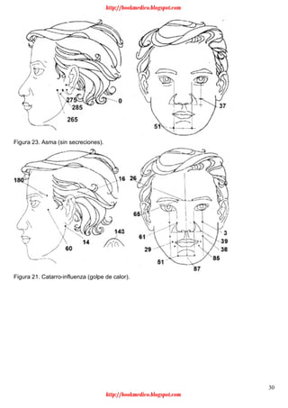 30
Figura 23. Asma (sin secreciones).
Figura 21. Catarro-influenza (golpe de calor).
http://bookmedico.blogspot.com
http://bookmedico.blogspot.com
 