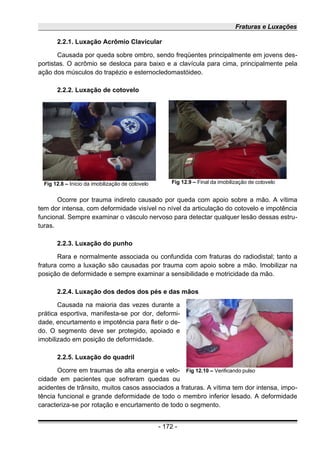 Fraturas e Luxações
2.2.1. Luxação Acrômio Clavicular
Causada por queda sobre ombro, sendo freqüentes principalmente em jovens des-
portistas. O acrômio se desloca para baixo e a clavícula para cima, principalmente pela
ação dos músculos do trapézio e esternocledomastóideo.
2.2.2. Luxação de cotovelo
Ocorre por trauma indireto causado por queda com apoio sobre a mão. A vítima
tem dor intensa, com deformidade visível no nível da articulação do cotovelo e impotência
funcional. Sempre examinar o vásculo nervoso para detectar qualquer lesão dessas estru-
turas.
2.2.3. Luxação do punho
Rara e normalmente associada ou confundida com fraturas do radiodistal; tanto a
fratura como a luxação são causadas por trauma com apoio sobre a mão. Imobilizar na
posição de deformidade e sempre examinar a sensibilidade e motricidade da mão.
2.2.4. Luxação dos dedos dos pés e das mãos
Causada na maioria das vezes durante a
prática esportiva, manifesta-se por dor, deformi-
dade, encurtamento e impotência para fletir o de-
do. O segmento deve ser protegido, apoiado e
imobilizado em posição de deformidade.
2.2.5. Luxação do quadril
Ocorre em traumas de alta energia e velo-
cidade em pacientes que sofreram quedas ou
acidentes de trânsito, muitos casos associados a fraturas. A vítima tem dor intensa, impo-
tência funcional e grande deformidade de todo o membro inferior lesado. A deformidade
caracteriza-se por rotação e encurtamento de todo o segmento.
- 172 -
Fig 12.8 – Início da imobilização de cotovelo Fig 12.9 – Final da imobilização de cotovelo
Fig 12.10 – Verificando pulso
 