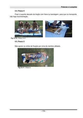 Fraturas e Luxações
4.4. Passo 4
Fixar o suporte elevado da tração com faixa ou bandagem, para que no transporte,
não haja movimentação.
4.5. Passo 5
Não apoiar os cintos de fixação por cima do membro afetado.
- 176 -
Fig 12.16 – Passo 3 e 4
Fig 12.17 – Passo 5
 