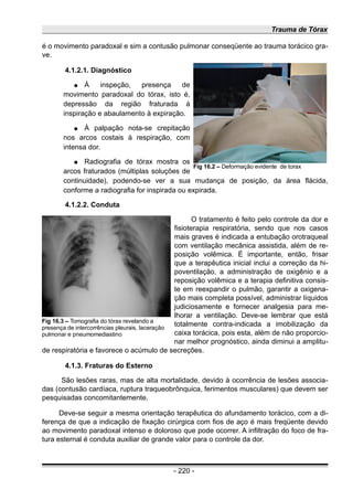 Trauma de Tórax
é o movimento paradoxal e sim a contusão pulmonar conseqüente ao trauma torácico gra-
ve.
4.1.2.1. Diagnóstico
● À inspeção, presença de
movimento paradoxal do tórax, isto é,
depressão da região fraturada à
inspiração e abaulamento à expiração.
● À palpação nota-se crepitação
nos arcos costais à respiração, com
intensa dor.
● Radiografia de tórax mostra os
arcos fraturados (múltiplas soluções de
continuidade), podendo-se ver a sua mudança de posição, da área flácida,
conforme a radiografia for inspirada ou expirada.
4.1.2.2. Conduta
O tratamento é feito pelo controle da dor e
fisioterapia respiratória, sendo que nos casos
mais graves é indicada a entubação orotraqueal
com ventilação mecânica assistida, além de re-
posição volêmica. É importante, então, frisar
que a terapêutica inicial inclui a correção da hi-
poventilação, a administração de oxigênio e a
reposição volêmica e a terapia definitiva consis-
te em reexpandir o pulmão, garantir a oxigena-
ção mais completa possível, administrar líquidos
judiciosamente e fornecer analgesia para me-
lhorar a ventilação. Deve-se lembrar que está
totalmente contra-indicada a imobilização da
caixa torácica, pois esta, além de não proporcio-
nar melhor prognóstico, ainda diminui a amplitu-
de respiratória e favorece o acúmulo de secreções.
4.1.3. Fraturas do Esterno
São lesões raras, mas de alta mortalidade, devido à ocorrência de lesões associa-
das (contusão cardíaca, ruptura traqueobrônquica, ferimentos musculares) que devem ser
pesquisadas concomitantemente.
Deve-se seguir a mesma orientação terapêutica do afundamento torácico, com a di-
ferença de que a indicação de fixação cirúrgica com fios de aço é mais freqüente devido
ao movimento paradoxal intenso e doloroso que pode ocorrer. A infiltração do foco de fra-
tura esternal é conduta auxiliar de grande valor para o controle da dor.
- 220 -
Fig 16.3 – Tomografia do tórax revelando a
presença de intercorrências pleurais, laceração
pulmonar e pneumomediastino
Fig 16.2 – Deformação evidente de torax
 