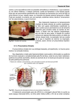 Trauma de Tórax
vando a uma equivalência entre as pressões atmosférica e intratorácica, o que ocasiona-
rá, em última instância, o colapso pulmonar, queda da hematose e uma hipóxia aguda.
Esse tipo de pneumotórax geralmente não é causado por ferimentos por arma de fogo ou
arma branca, já que, nesses casos, os músculos da parede torácica tamponam a lesão.
Pode ser causado, no entanto, por, por exemplo, acidentes viários, devido à "arrancamen-
tos" de caixa torácica, o que é incomum.
Seu tratamento baseia-se no tamponamento
imediato da lesão através de curativo quadrangu-
lar feito com gazes esterilizadas (vaselinada ou
outro curativo pouco permeável ao ar) de tamanho
suficiente para encobrir todas as bordas do feri-
mento, e fixado com fita adesiva (esparadrapo,
etc) em três de seus lados. A fixação do curativo
oclusivo em apenas três lados produz um efeito de
válvula; desse modo, na expiração, tem-se a saída
de ar que é impedido de retornar na inspiração,
evitando, assim, formar um pneumotórax hiperten-
sivo.
5.1.3. Pneumotórax Simples
O pneumotórax simples tem sua etiologia baseada, principalmente, no trauma pene-
trante e na contusão torácica.
Seu diagnóstico é dado pela hipersonoridade à percussão e diminuição ou ausência
de murmúrio vesicular e complementado pelo Rx de tórax, onde há uma maior radiotrans-
parência do pulmão acometido, devido ao acúmulo de ar no local que era para ser ocupa-
do pelo parênquima pulmonar.
O tratamento preconizado para ele (ATLS) é a drenagem pleural feita no quinto ou
sexto espaço intercostal (EIC), na linha axilar média (LAM), a fim de se evitar complica-
- 222 -
Fig 16.6 – Esquema de colocação de dreno em pneumotorax hipertensivo
Fig 16.5 – Curativo de 3 pontas
 